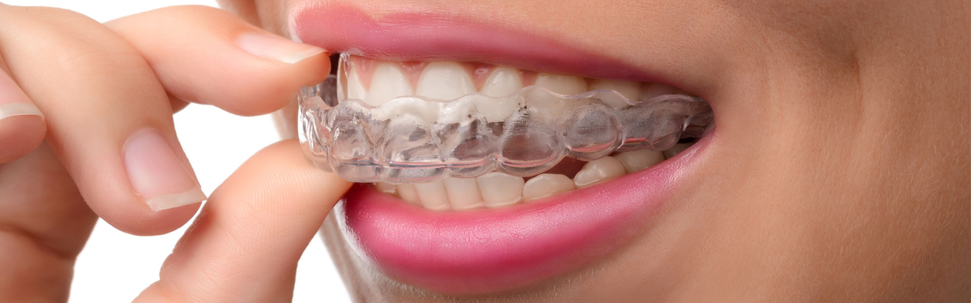 Top 3 Reasons You Want Invisalign Instead of Braces