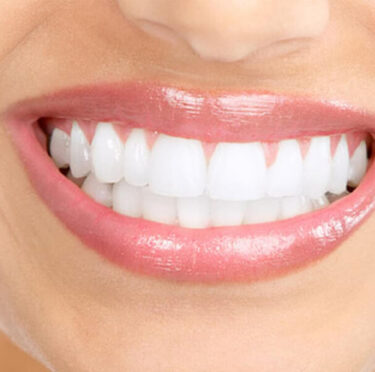Teeth Whitening Facts and Myths